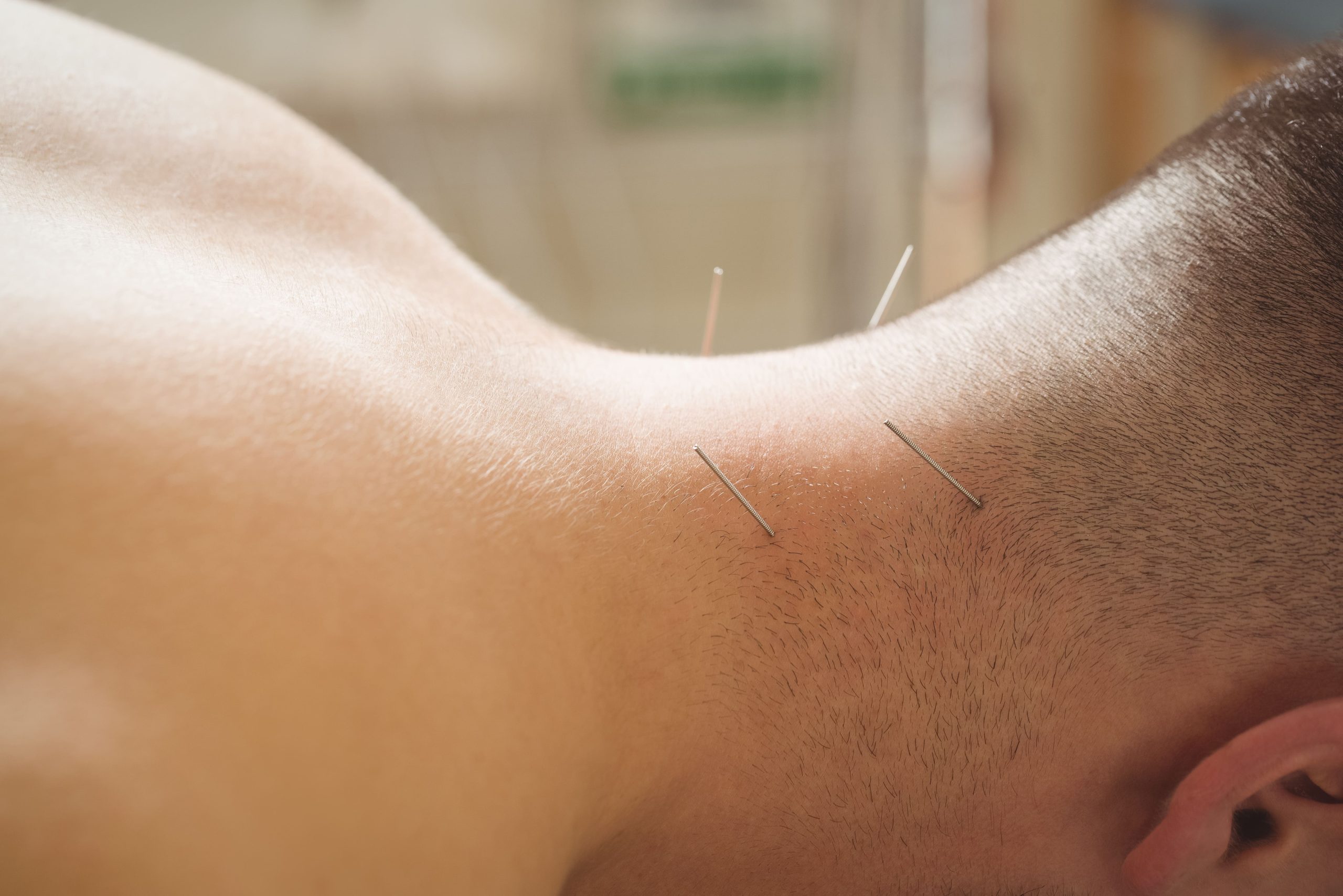 Augusta Acupuncture Clinic | Top Neck Pain Doctor in Augusta
