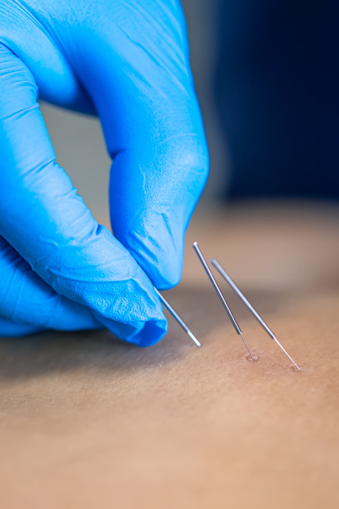 Augusta Acupuncture Clinic | Top Augusta Clinic for TMJ and Acupuncture