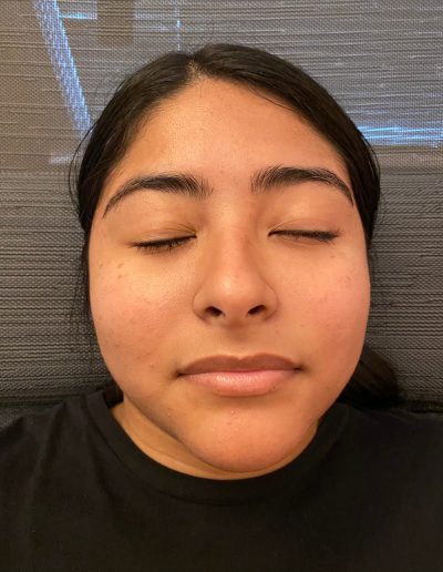 bells palsy after