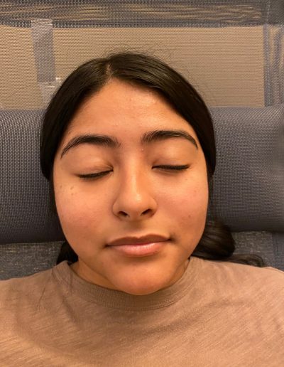 bells palsy before