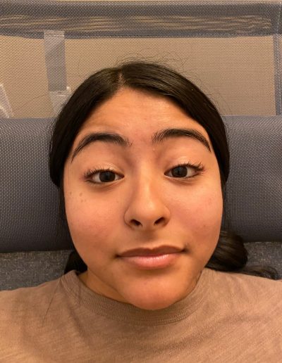 bells palsy before