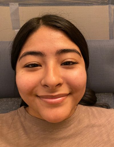 bells palsy after