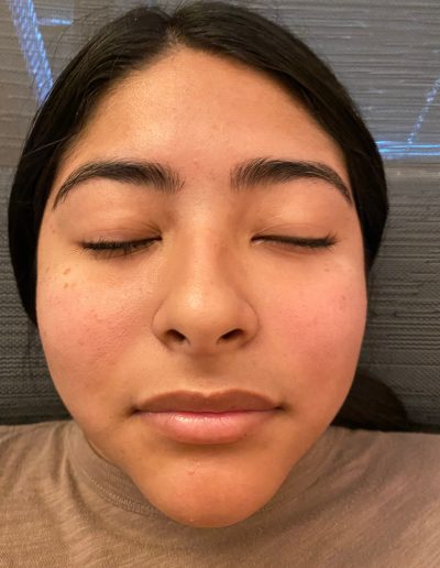 bells palsy face