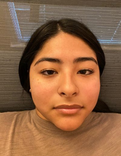 bells palsy after