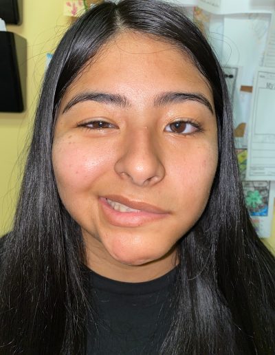 bells palsy face