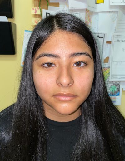 bells palsy face
