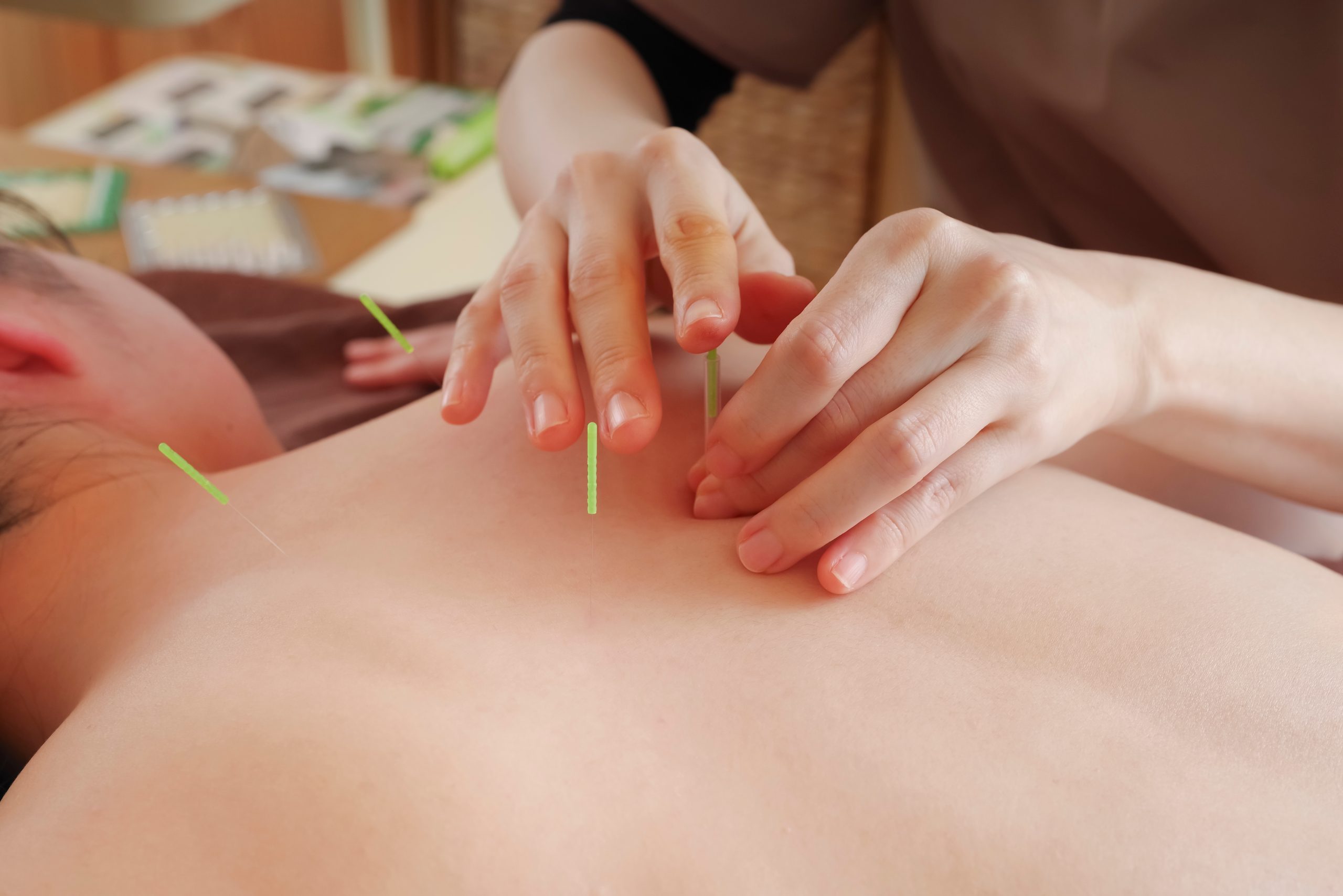 A woman doing acupuncture treatment